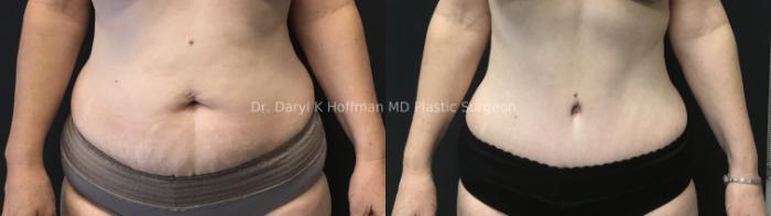 Tummy Tuck Case 82 Before & After Front | San Jose & Palo Alto, CA | Daryl K. Hoffman, MD