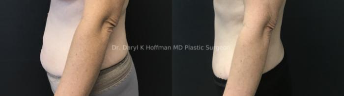 Tummy Tuck Case 82 Before & After Left Side | San Jose & Palo Alto, CA | Daryl K. Hoffman, MD