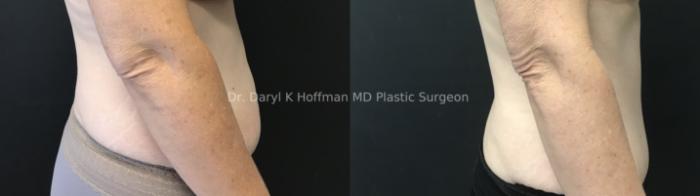 Tummy Tuck Case 82 Before & After Right sides | San Jose & Palo Alto, CA | Daryl K. Hoffman, MD