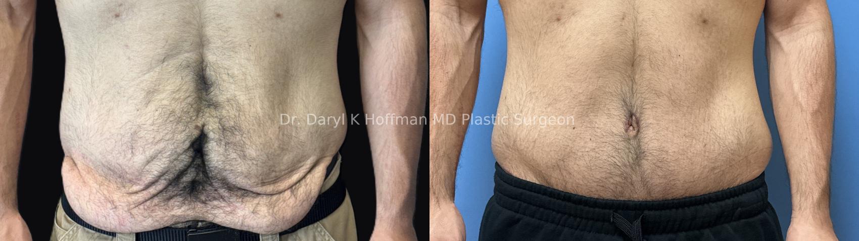 Tummy Tuck Case 89 Before & After Front | San Jose & Palo Alto, CA | Daryl K. Hoffman, MD