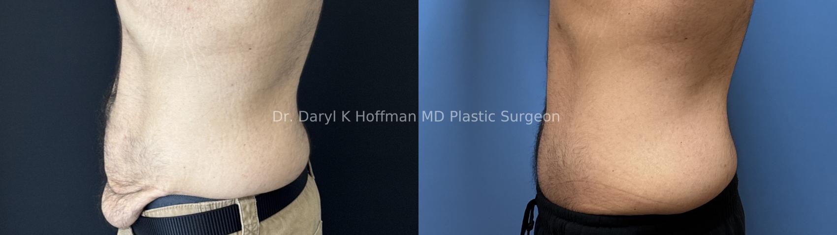 Tummy Tuck Case 89 Before & After Left Side | San Jose & Palo Alto, CA | Daryl K. Hoffman, MD