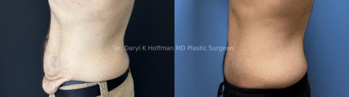 Tummy Tuck Case 89 Before & After Left Side | San Jose & Palo Alto, CA | Daryl K. Hoffman, MD