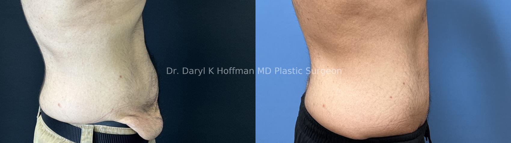 Tummy Tuck Case 89 Before & After Right Side | San Jose & Palo Alto, CA | Daryl K. Hoffman, MD