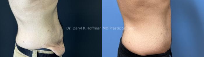 Tummy Tuck Case 89 Before & After Right Side | San Jose & Palo Alto, CA | Daryl K. Hoffman, MD